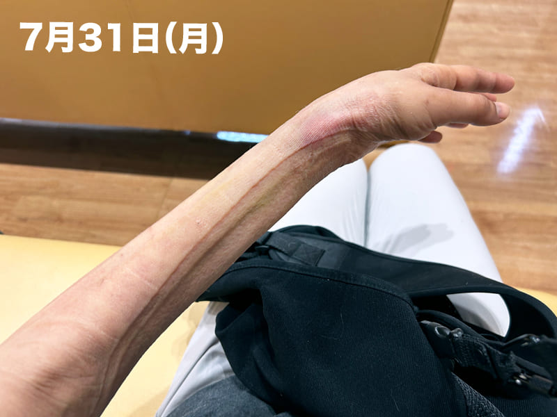 整形外科でギブスを外した直後の左腕の写真