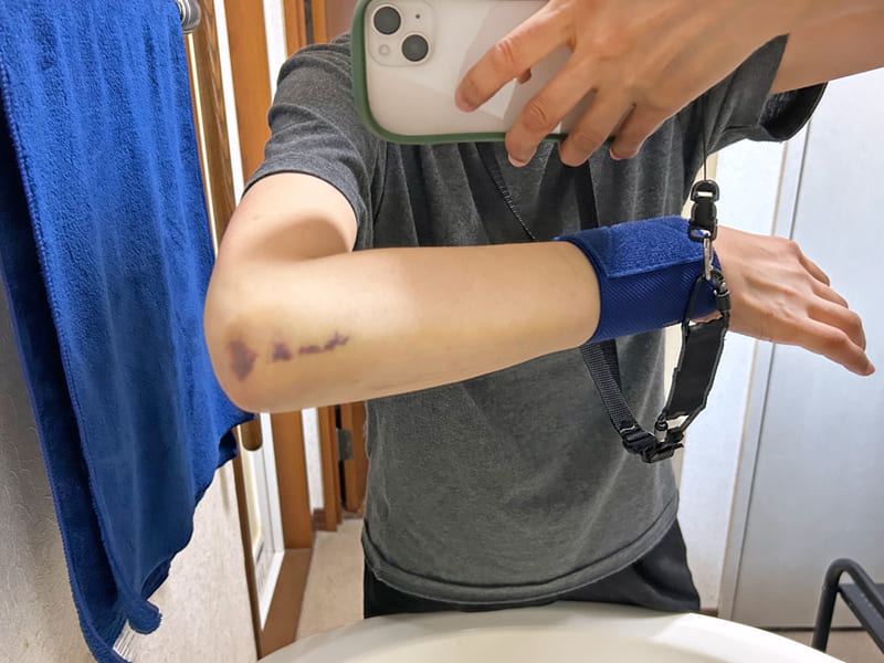 ギブスを外した日の左腕の内出血